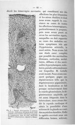Fig. 9. Variole. Péricapsulite et sclérose corticale - Exposé des titres et des travaux scientifique [...]