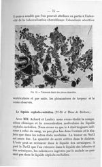 Fig. 12. Tubercule limité des plexus choroïdes - Exposé des titres et des travaux scientifiques. Jan [...]