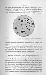 Fig. 13. Frottis sur lames du culot de centrifugation du liquide céphalorachidien d'un sarcome céréb [...]