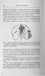 Fig. 1. On voit la caverne ouverte à la face postérieure du poumon droit et le ganglion comprimant l [...]