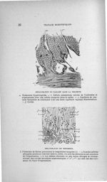 Organisation du caillot dans la phlébite / Organisation du thrombus - Concours d'agrégation, 1906, T [...]
