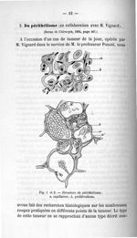 Fig. 1 et 2. Structure du périthéliome - Concours pour l'agrégation, 1907, section de pathologie int [...]