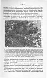 Fig. 1. Tuberculose mammaire au 30e jour - Exposé des titres et travaux scientifiques