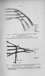 Fig. 1. Schéma de l'architecture du plexus brachial chez le nouveau-né / Fig. 2. Photographie d'un p [...]