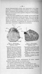 Fig. 1. Hémorragie du pédoncule cérébelleux supérieur droit / Fig. 2. Hémorragie du pédoncule cérébe [...]