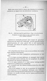 Fig. 14. Méningo-myélite syphilitique (Type Aran-Duchenne) - Titres et travaux scientifiques