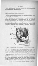 Fig. 15. Tumeur du trou occipital. - Compression du bulbe - Titres et travaux scientifiques