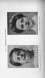 Fig. 17. Hémispasme facial hystérique - Titres et travaux scientifiques