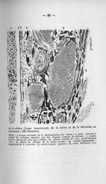 Fig. 6. Paralysie générale. Atrophie papillaire et décollement de la rétine. Coupe transversale de l [...]