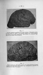 Fig. 8. Atrophie bilatérale symétrique des lobes frontaux : hémisphère droit / Fig. 9. Sclérose tubé [...]