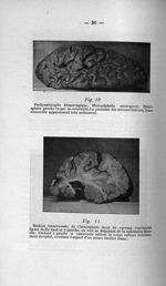 Fig. 10. Pachyméningite hémorragique. Microcéphalie microgyrie / Fig. 11. Section transversale de l' [...]