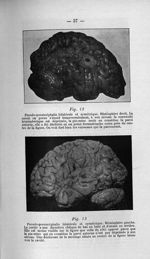 Fig. 12. Pseudo-porencéphalie bilatérale et symétrique. Hémisphère droit / Fig. 13. Pseudo-porencéph [...]