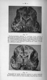 Fig. 14. Pseudo-porencéphalie bilatérale et symétrique. Coupe verticale et transversale des hémisphè [...]