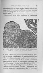 Fig. 2. Coupe à travers une granulation endocardique ; structure fibrineuse - Titres et travaux scie [...]