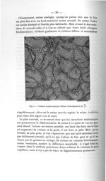Fig. 5. Cirrhose hypertrophique diffuse - Exposé des titres et des travaux scientifique, janvier 190 [...]