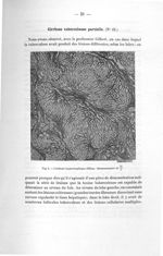 Fig. 6. Cirrhose hypertrophique diffuse - Exposé des titres et des travaux scientifique, janvier 190 [...]