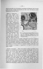 Fig. 3. Cirrhose hypertrophique biliaire avec abcès - Exposé des titres et travaux scientifiques, ja [...]