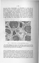 Fig. 4. Cirrhose biliaire avec lésions angiocholitiques marquées - Exposé des titres et travaux scie [...]