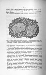 Fig. 13. Coupe du lobe gauche du foie dans un cas de splénomégalie méta-ictérique - Exposé des titre [...]