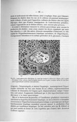 Fig. 16. Angio- pancréatite diabétigène - Exposé des titres et travaux scientifiques, janvier 1907