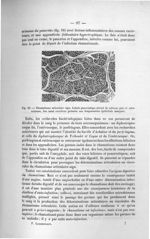 Fig. 18. Rhumatisme articulaire aigu - Exposé des titres et travaux scientifiques, janvier 1907