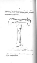 Fig. 3. Décalquée sur radiographie. Fracture du 3e métacarpien gauche. A. Vue de face ; B. Vue de pr [...]