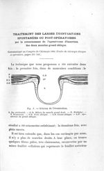 Fig. 1. Schéma de l'éventration - Titres et travaux scientifiques du Dr Raoul Baudet, concours d'agr [...]