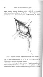 Fig. 7. Le lipome herniaire vu après ouverture du canal inguinal - Titres et travaux scientifiques