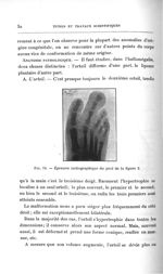 Fig. 13. Épreuve radiographique du pied de la figure 2 - Titres et travaux scientifiques