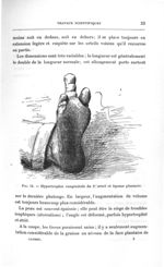 Fig. 14. Hypertrophie congénitale du 2e orteil et lipome plantaire - Titres et travaux scientifiques