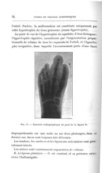 Fig. 15. Épreuve radiographique du pied de la figure 14 - Titres et travaux scientifiques