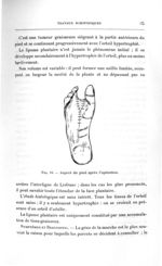 Fig. 16. Aspect du pied après l'opération - Titres et travaux scientifiques