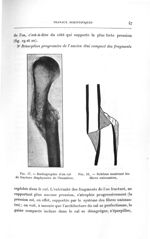 Fig. 17. Radiographie d'un cal de fracture diaphysaire de l'humérus / Fig. 18. Schéma montrant les f [...]