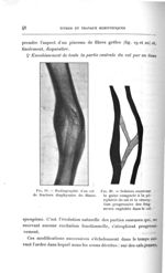 Fig. 19. Radiographie d'un cal de fracture diaphysaire du fémur / Fig. 20. Schéma montrant la gaine  [...]