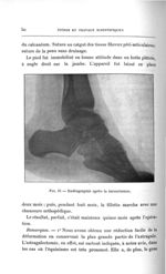 Fig. 21. Radiographie après la tarsectomie - Titres et travaux scientifiques