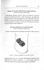 Fig. 22. Sarcome mélanique de la plante du pied - Titres et travaux scientifiques