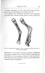 Fig. 25. Déformation rachitique. Coupe (grandeur naturelle) des deux os de l'avant-bras gauche - Tit [...]