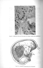 Fig. 28. Métastase méningée d'un cancer de l'estomac, pseudo-tubes gandulaires / Fig. 29. Granulie c [...]