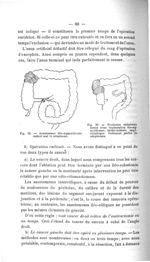 Fig. 38. Anastomose iléo-sigmoidienne isolant mal le néoplasme / Fig. 39. Exclusion unilatérale ferm [...]