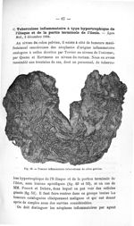 Fig. 49. Tumeur inflammatoire tuberculeuse du côlon pelvien - Concours d'agrégation, chirurgie, 1907 [...]