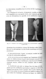 Fig. 53. Ankylose de la hanche ou rectitude avec raccourcissement, équinisme et pied creux - Concour [...]