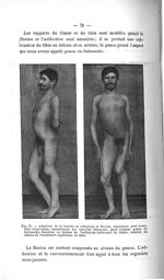 Fig. 55. Ankylose de la hanche en adduction et flexion, équinisme, pied creux, tibia récurvatum, enr [...]