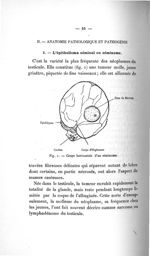 Fig. 1. Coupe horizontale d'un séminome - Titres et travaux
