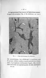 Fig. 2. Coupe microscopique d'un Séminome - Titres et travaux