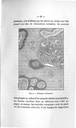 Fig. 4. Adénome testiculaire - Titres et travaux