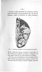 Fig. 5. Embryome testiculaire en voie de dégénérescence maligne - Titres et travaux