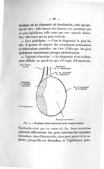 Fig. 7. Graphique d'une hématocèle après examen clinique - Titres et travaux