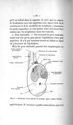 Fig. 8. Graphique d'une syphilis du testicule après examen clinique - Titres et travaux