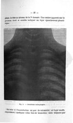 Fig. 3. Deuxième radiographie - Concours d'agrégation de médecine, avril 1907. Exposé des titres et  [...]