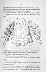 Fig. 3. Résection de la lame épiploïque - Exposé des titres & travaux scientifiques
